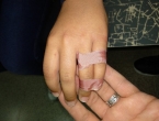 Rotura falange dedo meñique