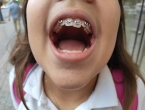 Brackets
