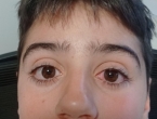 Conjuntivitis
