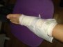 20190214 Esguince de tobillo